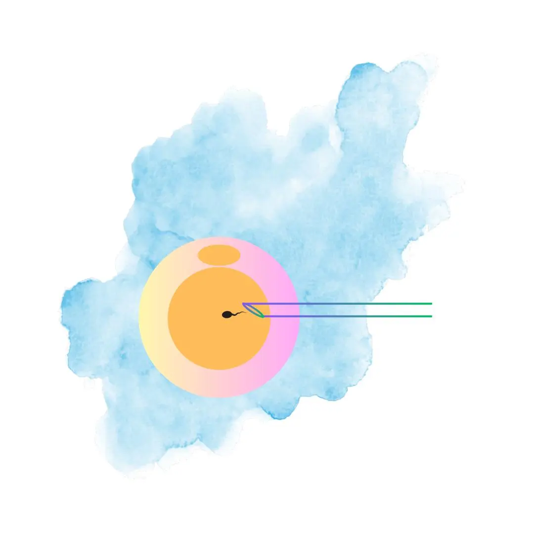 Module - 4 Intracytoplasmic Sperm Injection 